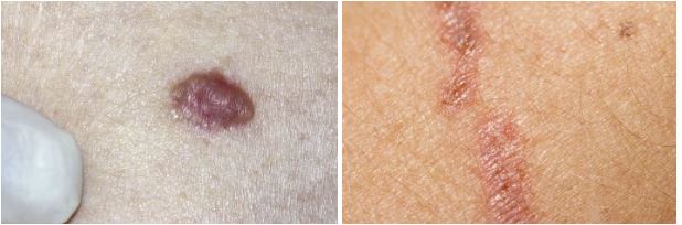 basal cell carcinoma skin cancer