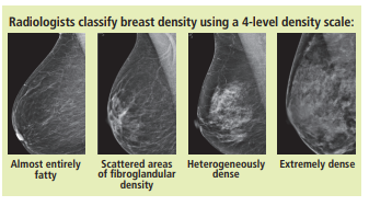 breastdensityx-ray