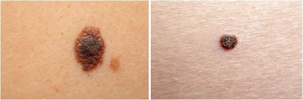 melanoma skin cancer