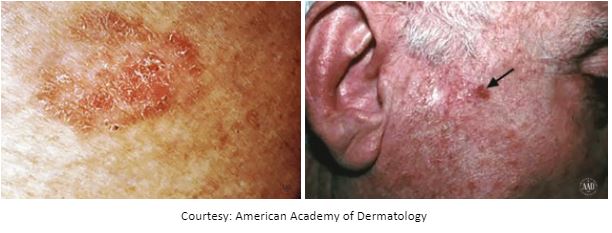 squamous cell carcinoma skin cancer