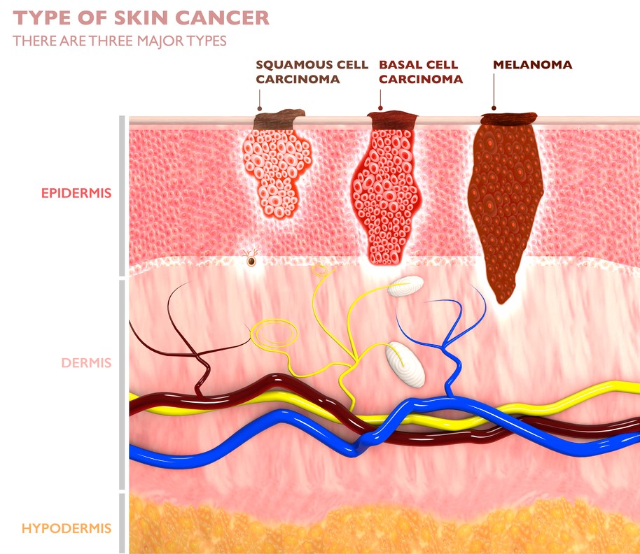 visualoflayersofskincancer