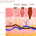 visualoflayersofskincancer