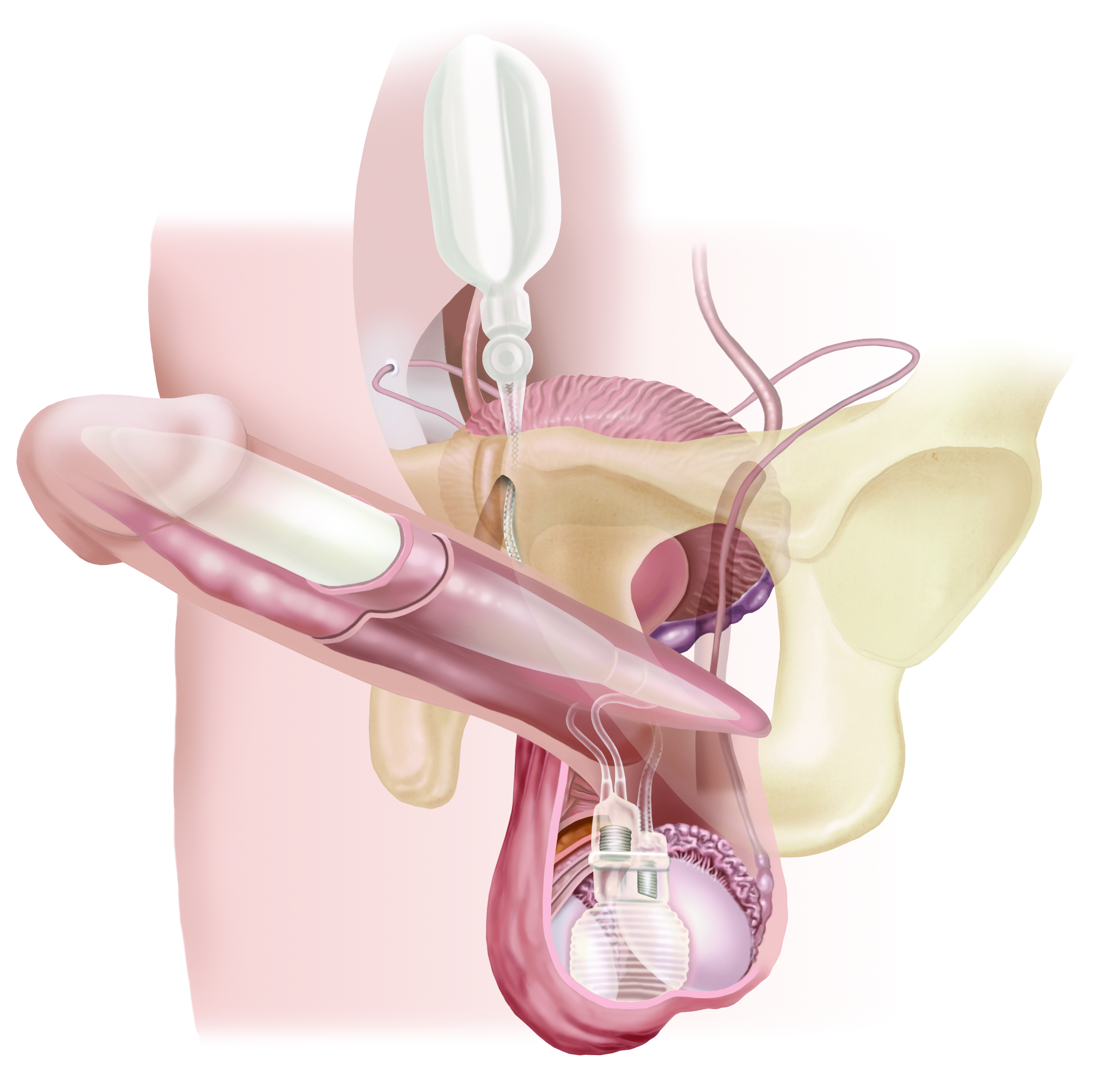 PenileImplant
