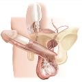 PenileImplant