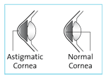 Normal cornea vs astigmatic cornea
