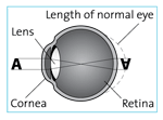 Eye shape with farsightedness