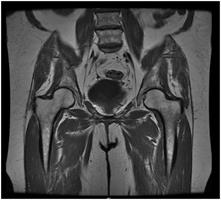 Pelvis MRI