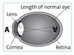Eye shape with nearsightedness