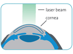 Diagram showcasing eye cornea and laser beam