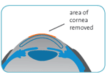 Area of cornea removed by PRK surgery