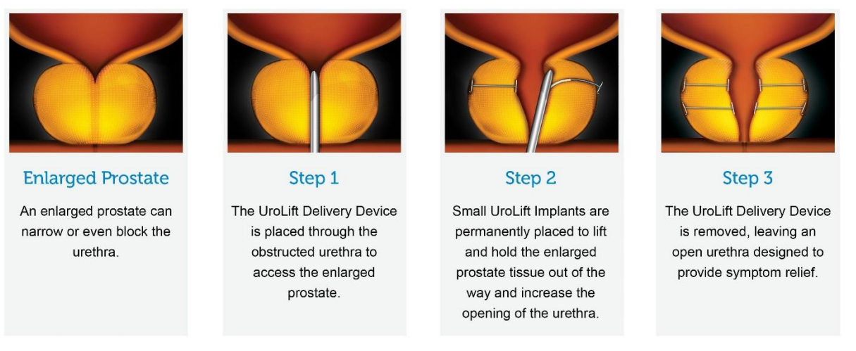 UroLift System for Enlarged Prostate