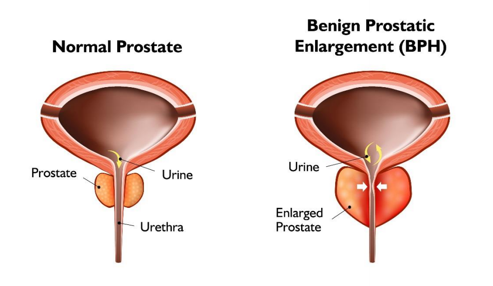 Normal and Enlarged Prostate