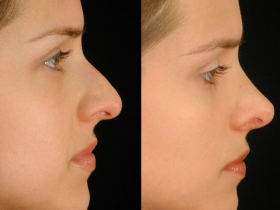 RhinoplastyBeforeandAfter