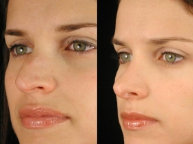 RhinoplastyBeforeandAfter