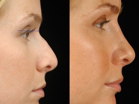 RhinoplastyBeforeandAfter