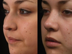 RhinoplastyBeforeandAfter