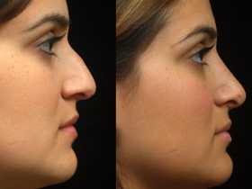 RhinoplastyBeforeandAfter